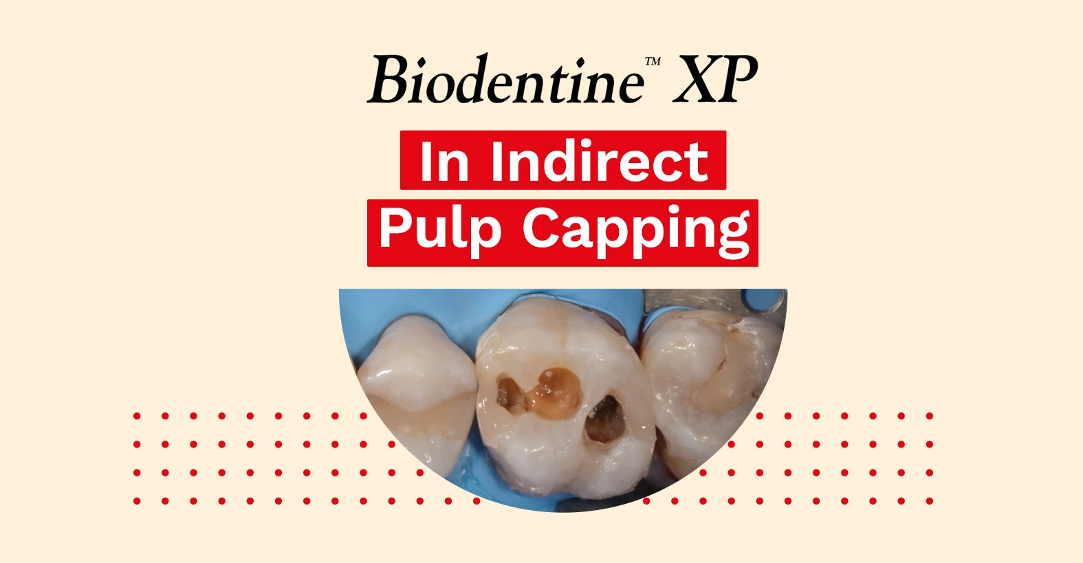 indirect-pulp-capping-dr-ganowicz-septodont-uk
